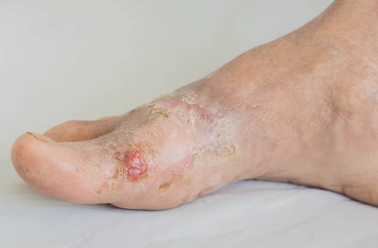 Zdjęcie 5 chorób, które rozpoznasz po swoich stopach! #2