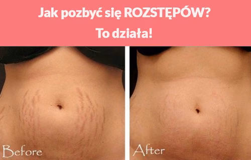 Jak pozbyć się ROZSTĘPÓW?