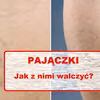 Zauważyłaś na swoim ciele tzw PAJĄCZKI? Pozbądź się ich domowym sposobem