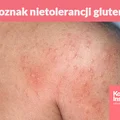 7 oznak nietolerancji glutenu