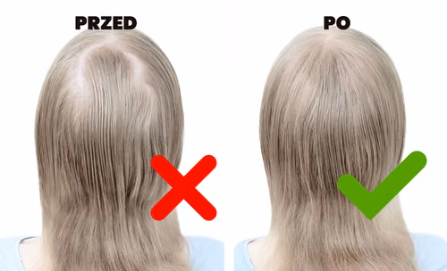 Wypróbuj genialną maseczkę, która przyspieszy POROST WŁOSÓW