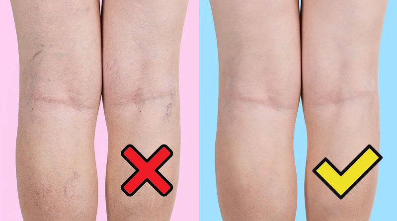 HIT medycyny naturalnej! Zniweluj cellulit, pajączki oraz żylaki. Sprawdź koniecznie!