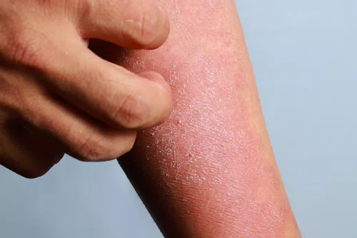 Jakim chorobom towarzyszy sucha i swędząca skóra?