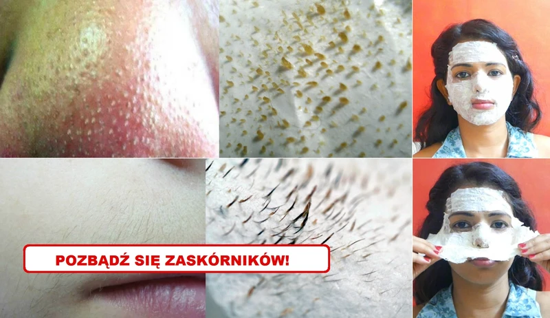 Poznaj 2 najlepsze sposoby na ZASKÓRNIKI