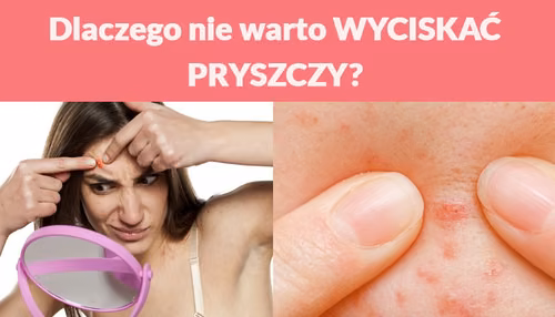 Dlaczego nie warto WYCISKAĆ PRYSZCZY?