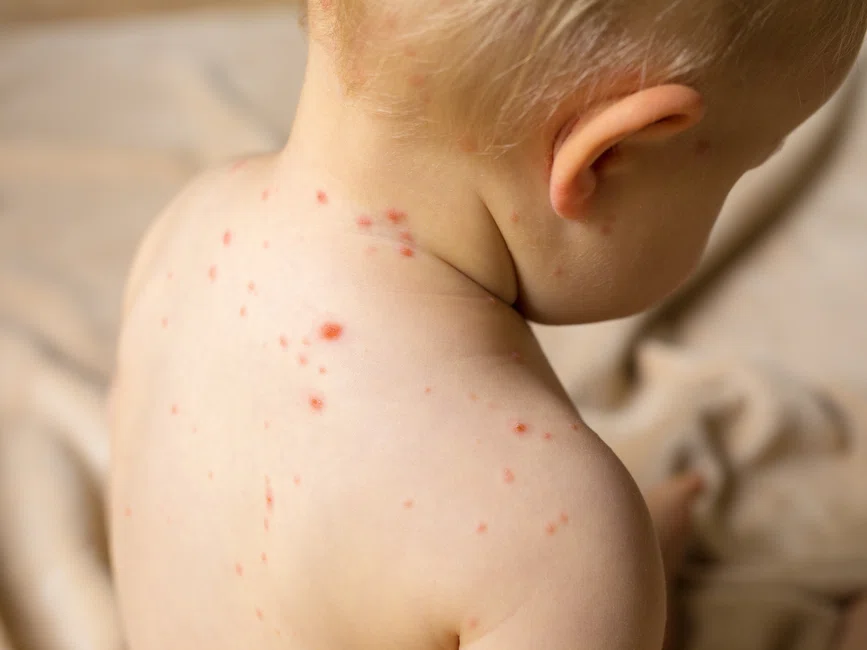 Choroby zakaźne u dzieci - czym się objawiają, kiedy szczepić i jakie są powikłania?