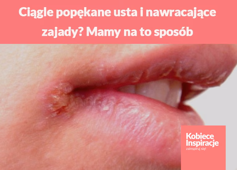 Ciągle popękane usta i nawracające zajady? Mamy na to sposób