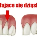 Sprawdź jak rozwiązać problem ODSUNIĘTYCH DZIĄSEŁ!