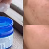 Dlaczego maść VapoRub tak skutecznie zwalcza trądzik?
