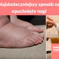 Najskuteczniejszy sposób na opuchnięte nogi