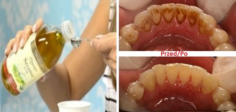 Czym jest OIL PULLING? I dlaczego płukanie ust olejem ma wiele korzyści?