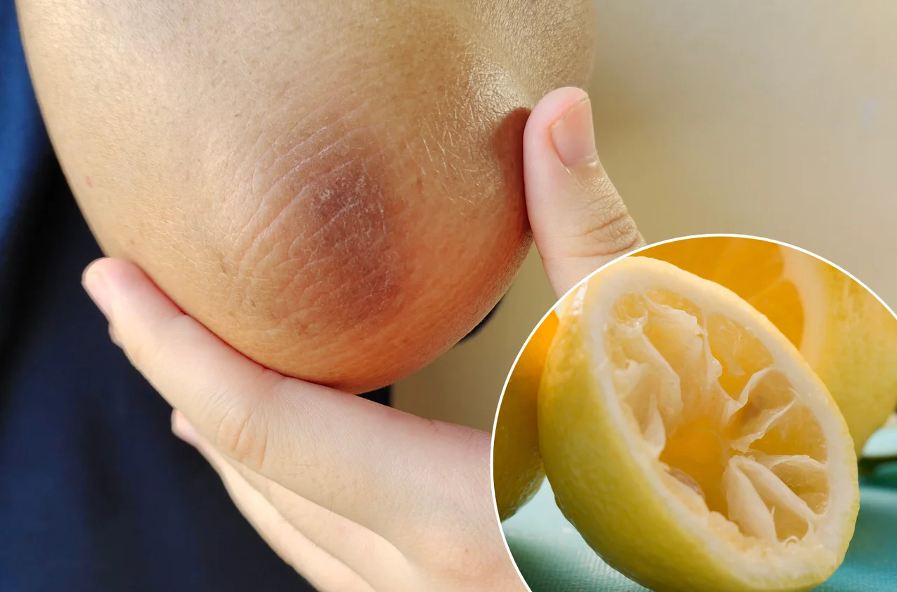 Cytryna na łokcie i kolana – ten szybki trik rozjaśni ciemną skórę w kilka dni