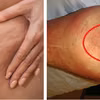 Czy wiesz, że cellulit i cellulitis to dwie zupełnie różne rzeczy? Poznaj różnice
