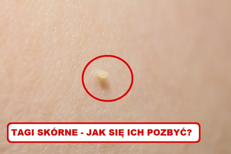TAGI SKÓRNE – Zobacz jak się ich pozbyć