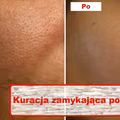 Wypróbuj kurację która zniweluje otwarte PORY