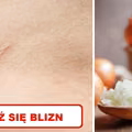 Wykorzystaj właściwości CEBULI i zmniejsz widoczność BLIZN!