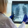 Światowy Dzień Gruźlicy: Walka z Jedną z Najstarszych Chorób Zakaźnych