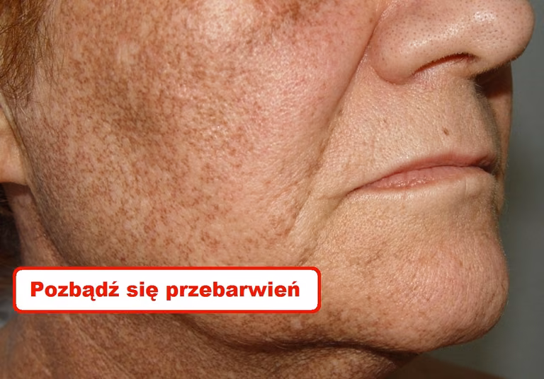 Naturalne sposoby na PRZEBARWIENIA NA SKÓRZE