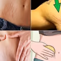 4 domowe sposoby na pozbycie się rozstępów!