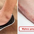 GRZYBICA? Wypróbuj naturalne sposoby!