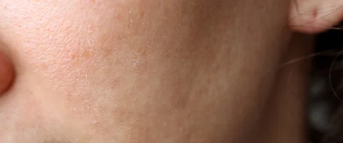 Jak zadbać o atopową skórę?