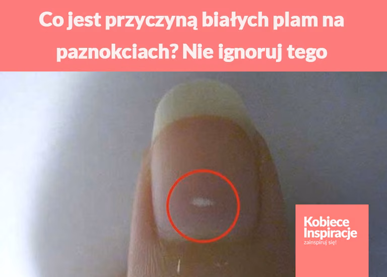 Co jest przyczyną białych plam na paznokciach? Nie ignoruj tego