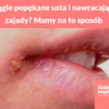 Ciągle popękane usta i nawracające zajady? Mamy na to sposób