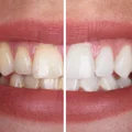 Biały uśmiech bez wizyty u dentysty? Odkryj sekretny składnik z Twojej kuchni!