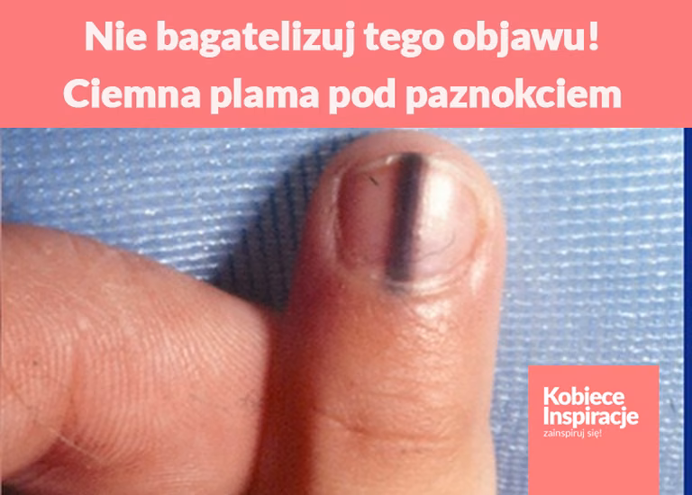 Nie bagatelizuj tego objawu! Ciemna plama pod paznokciem może świadczyć o poważnej chorobie