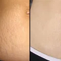 Skuteczny peeling na rozstępy - tylko dwa składniki!