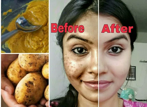 Przecieranie twarzy ziemniakiem – nie uwierzysz co to daje!