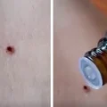 Usuwanie KLESZCZA przy pomocy OLEJKU MIĘTOWEGO? Lepiej tego nie rób!