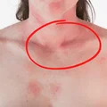 Robią Ci się czerwone plamy ze stresu? Musisz to wiedzieć!