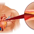 Sprawdź metody na OBNIŻENIE CHOLESTEROLU!