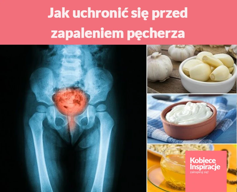 Jak uchronić się przed zapaleniem pęcherza