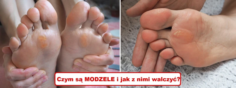MODZELE – pozbądź się ich domowymi sposobami!