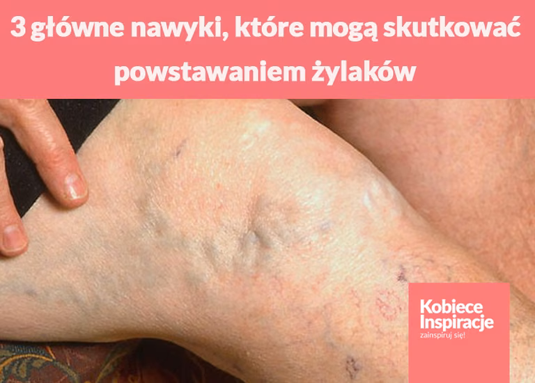 3 główne nawyki, które mogą skutkować powstawaniem żylaków. Większość z nas sama się o nie prosi..