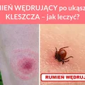 RUMIEŃ WĘDRUJĄCY po ukąszeniu KLESZCZA – jak leczyć?