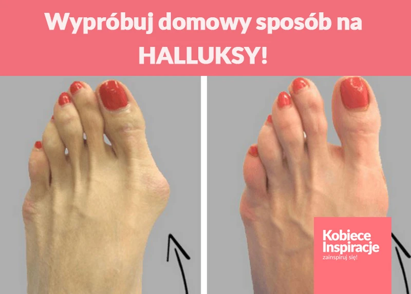 Wypróbuj domowy sposób na HALLUKSY!