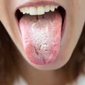 Dieta przeciwgrzybicza- co jeść, czego unikać?