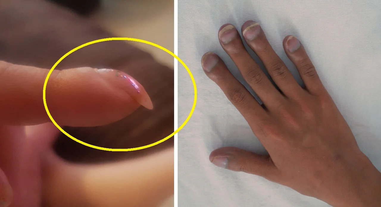 Udostępniła zdjęcie swojego zakrzywionego paznokcia. Szybko okazało się, że ma raka!