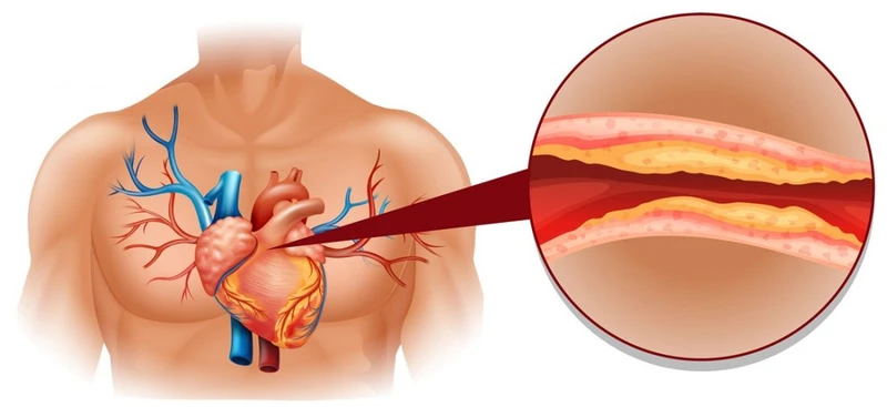 Sprawdź metody na OBNIŻENIE CHOLESTEROLU!