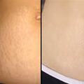 Skuteczny peeling na rozstępy - tylko dwa składniki!