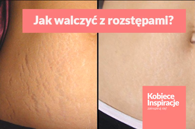 Jak walczyć z rozstępami? Pomoże Ci w tym kawa i oliwa z oliwek