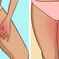 Masz ciemniejszą skórę na udach? Sprawdź co może Ci pomóc