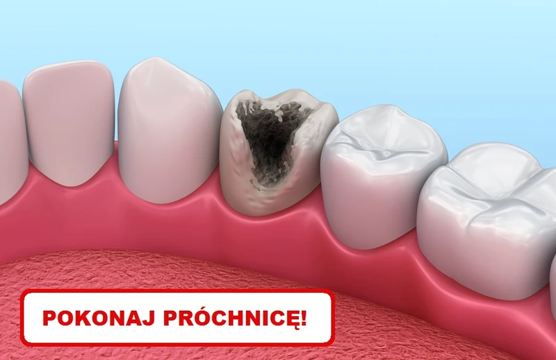Zobacz jak samemu zwalczyć PRÓCHNICĘ!