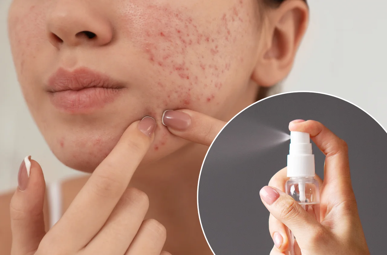 Ten płyn do dezynfekcji leczy trądzik lepiej niż drogie kosmetyki!