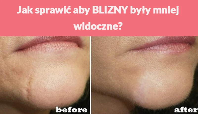 Jak sprawić aby BLIZNY były mniej widoczne?