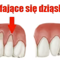 Sprawdź jak rozwiązać problem ODSUNIĘTYCH DZIĄSEŁ!