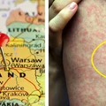 Nowe ognisko odry w Polsce. Jakich objawów nie wolno ignorować?